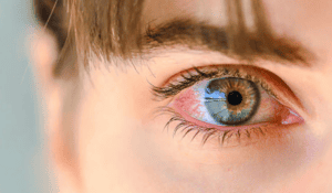 Lees meer over het artikel Ontstoken Oog: Wat te Doen bij een Geïrriteerd Oog