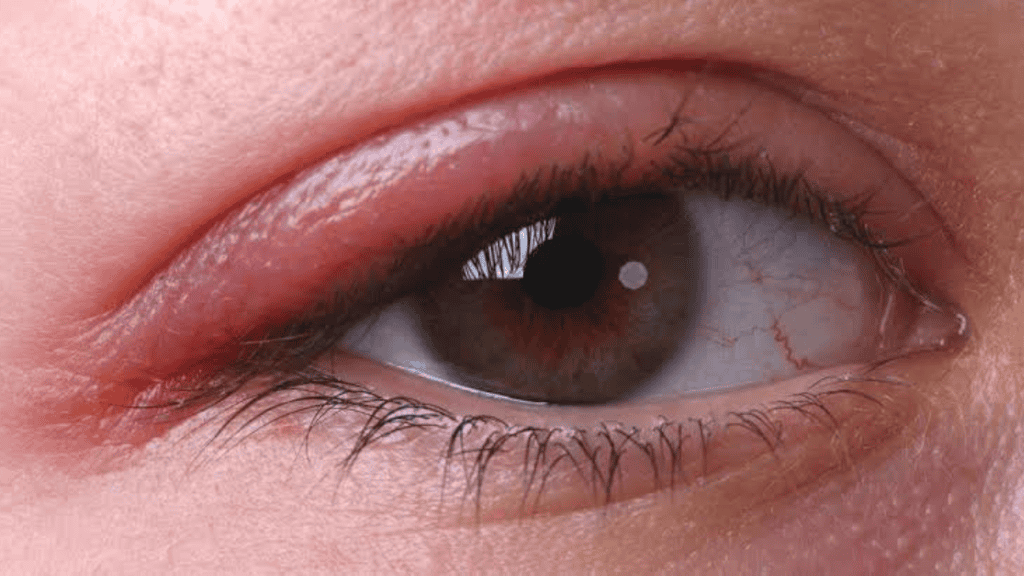 Ontstoken oog