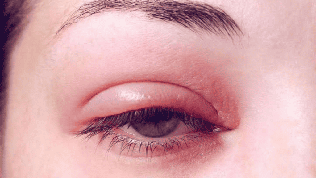 Ontstoken oog
